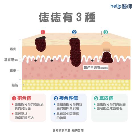 屁股長黑痣|痣形成的原因？痣長毛、痣變多變大是痣病變？5招判。